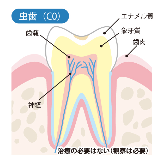 等々力（世田谷区）の歯医者、新開歯科医院のむし歯治療