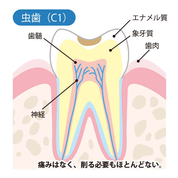等々力（世田谷区）の歯医者、新開歯科医院のむし歯治療