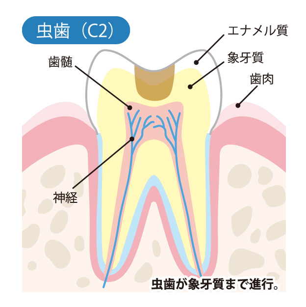 等々力（世田谷区）の歯医者、新開歯科医院のむし歯治療