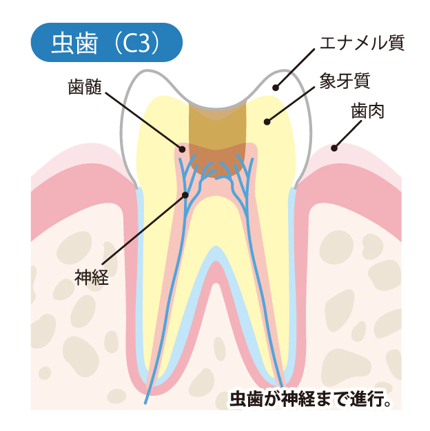 等々力（世田谷区）の歯医者、新開歯科医院のむし歯治療