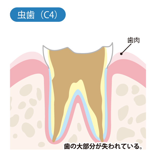 等々力（世田谷区）の歯医者、新開歯科医院のむし歯治療