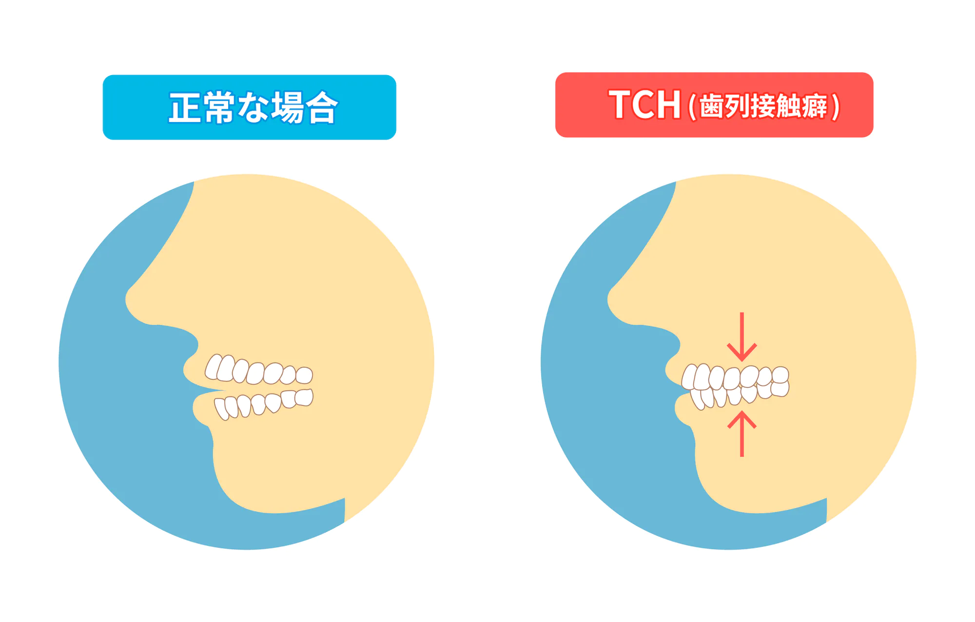 等々力（世田谷区）の歯医者、新開歯科医院の歯ぎしり、食いしばり