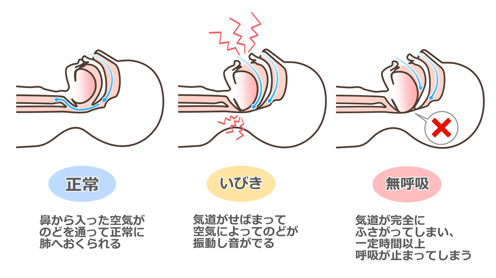 等々力（世田谷区）の歯医者、新開歯科医院の睡眠時無呼吸症候群