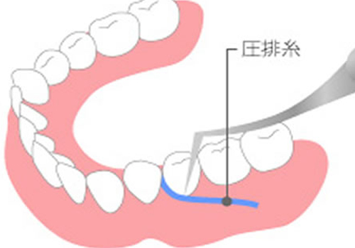 等々力（世田谷区）の歯医者、新開歯科医院の審美歯科治療